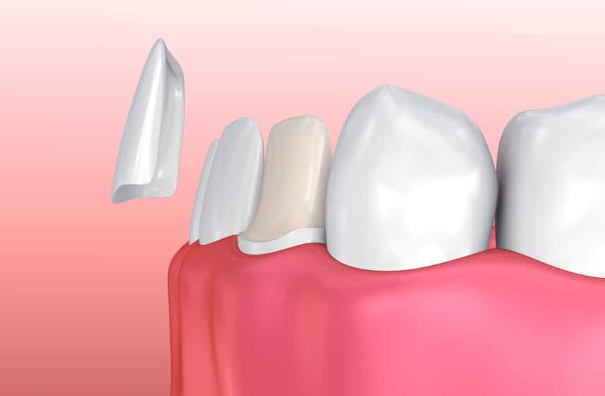 5 Things You Must Know Before Getting Dental Veneers