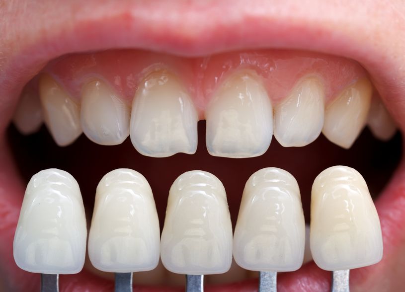 Uses of Ceramic Veneers in Dentistry
