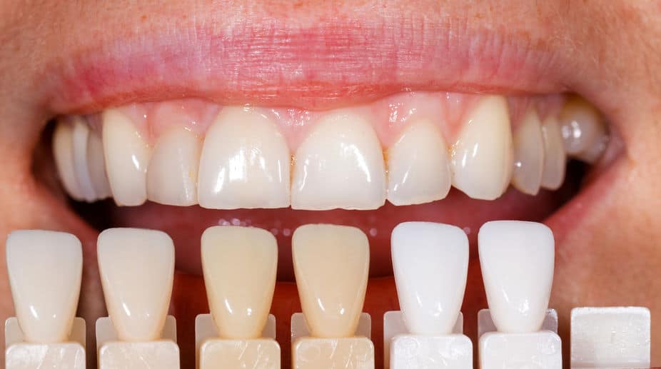Why Ceramic Veneers Might Be a Good Option for You