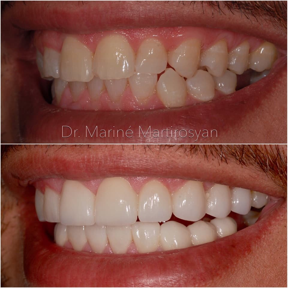 before and after veneers by dr marine (21)