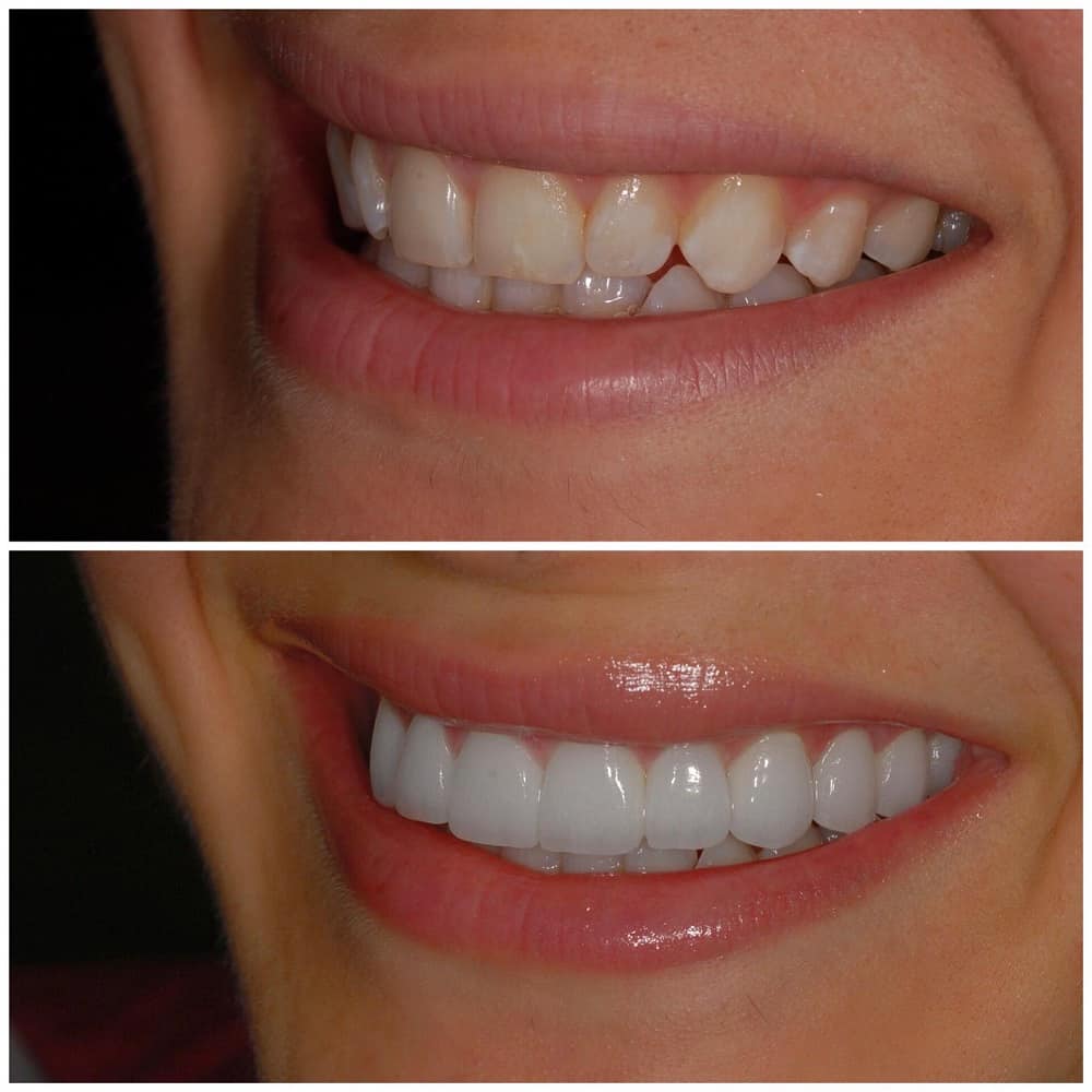 dr marine veneers before and after
