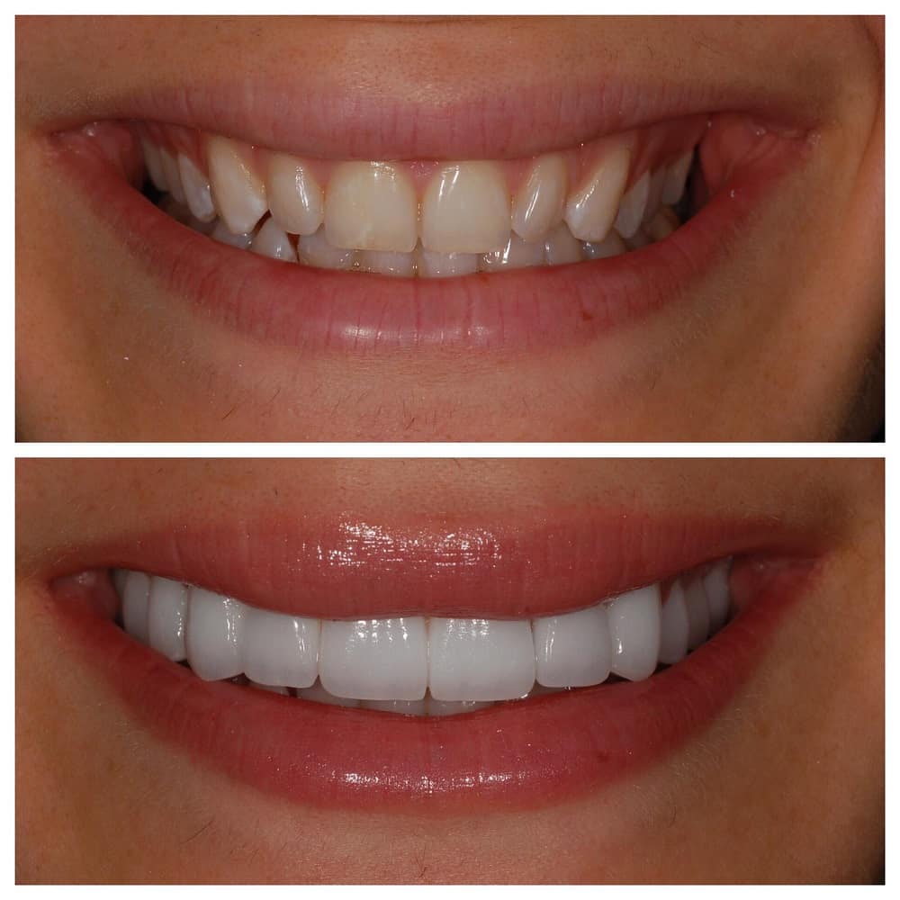 dr marine veneers before and after7