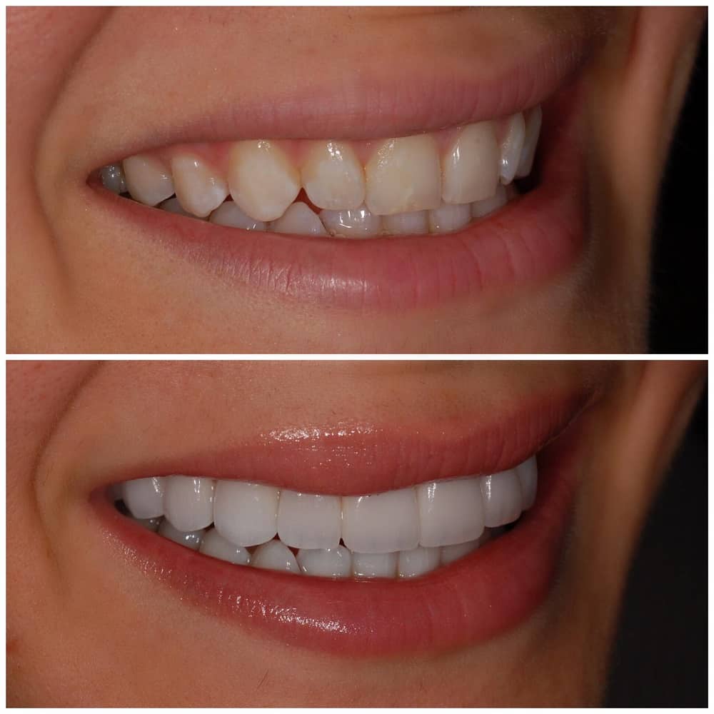 dr marine veneers before and after8