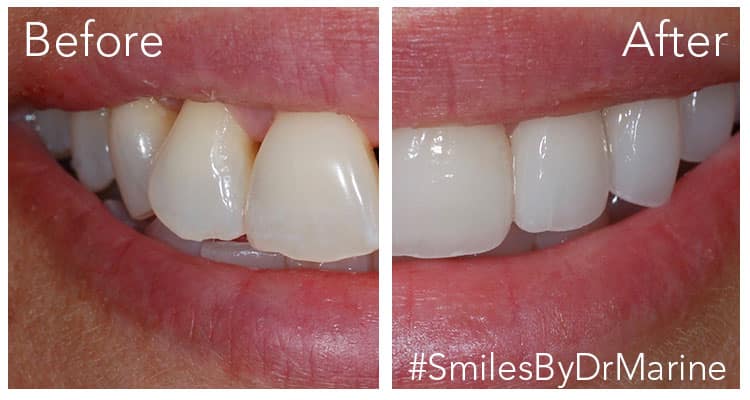 before and after veneers by dr marine