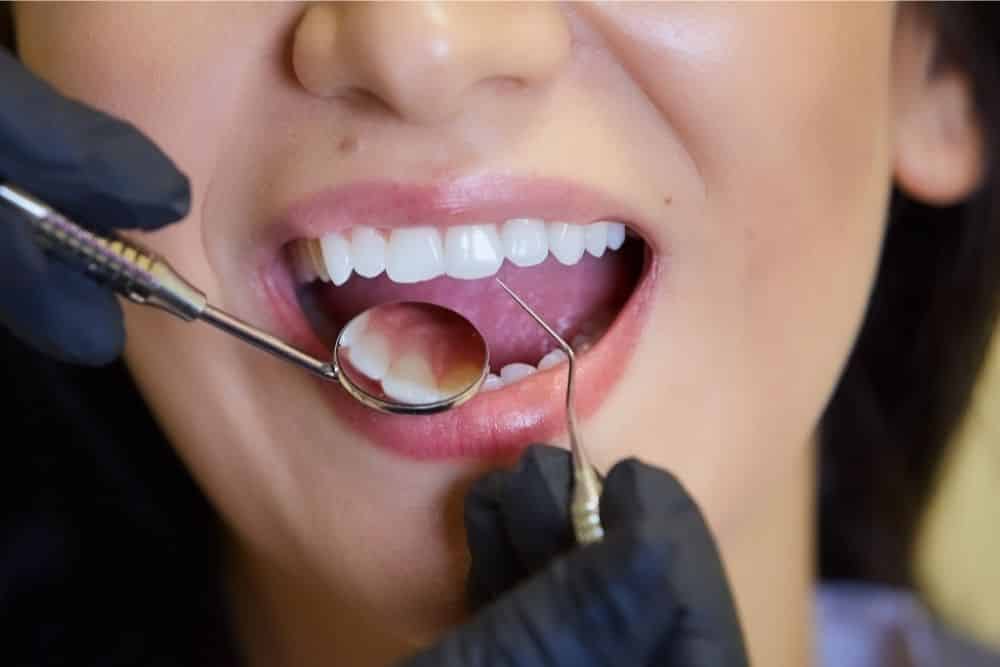 Dental Veneers Blog